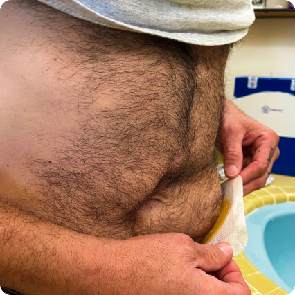 närbild av en mage med en stomi