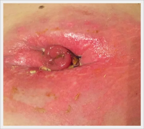 KONTAKTOWE ZAPALENIE SKÓRY