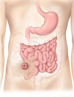 Ileostomie