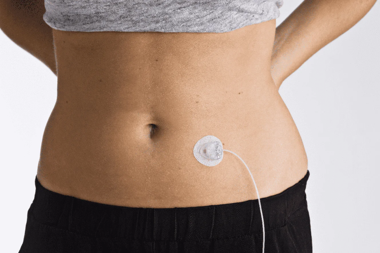 Image of infusion set on a lady's torso