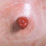 A Protruding Stoma